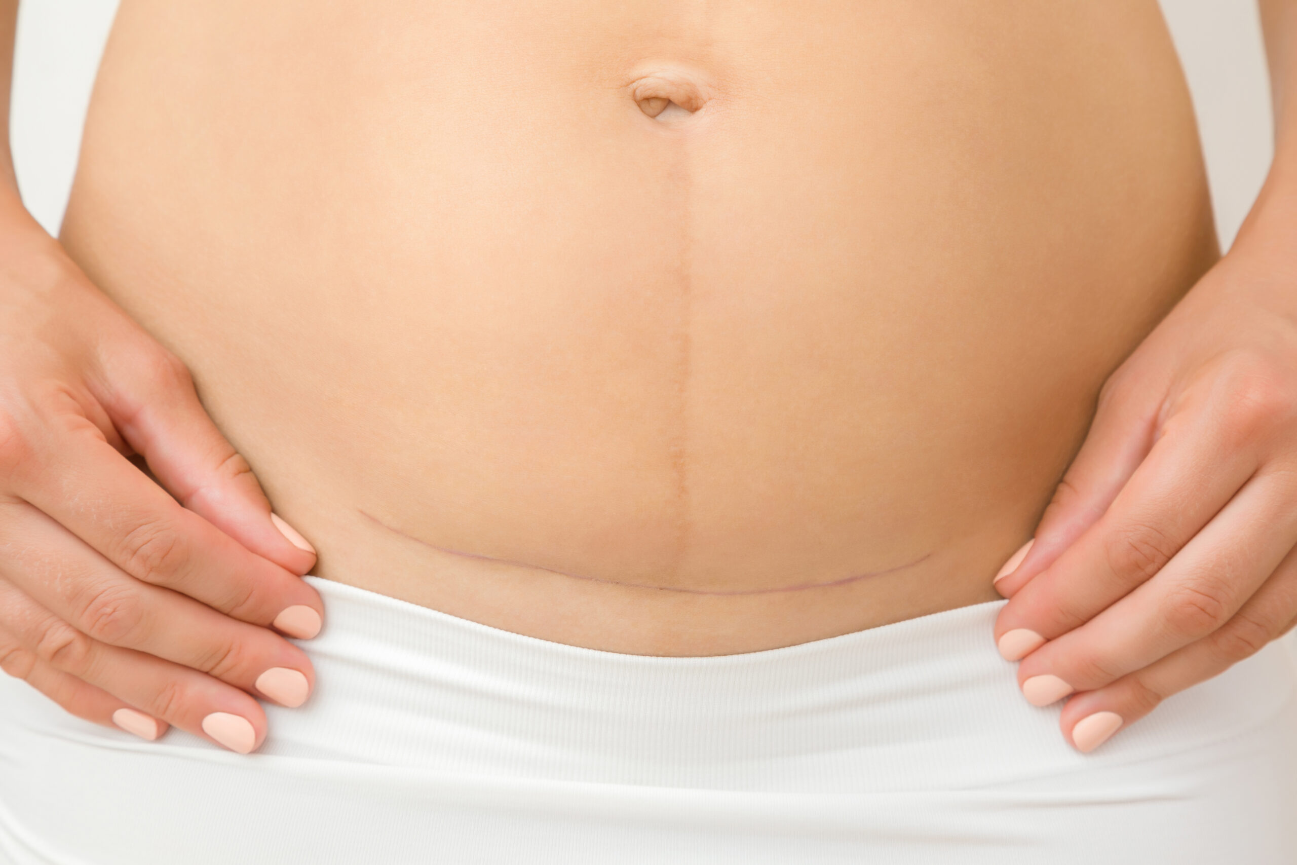 Postpartum Recovery: Best Belly Wrap for Vaginal & C-section Births