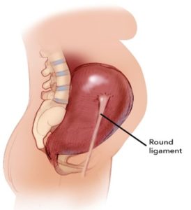 Round ligament pain in pregnancy